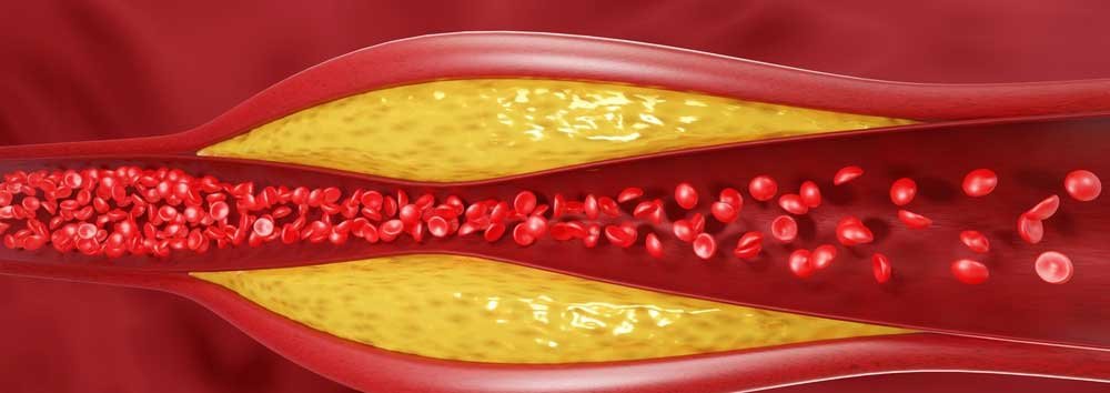 Symptoms Of Bad Cholesterol